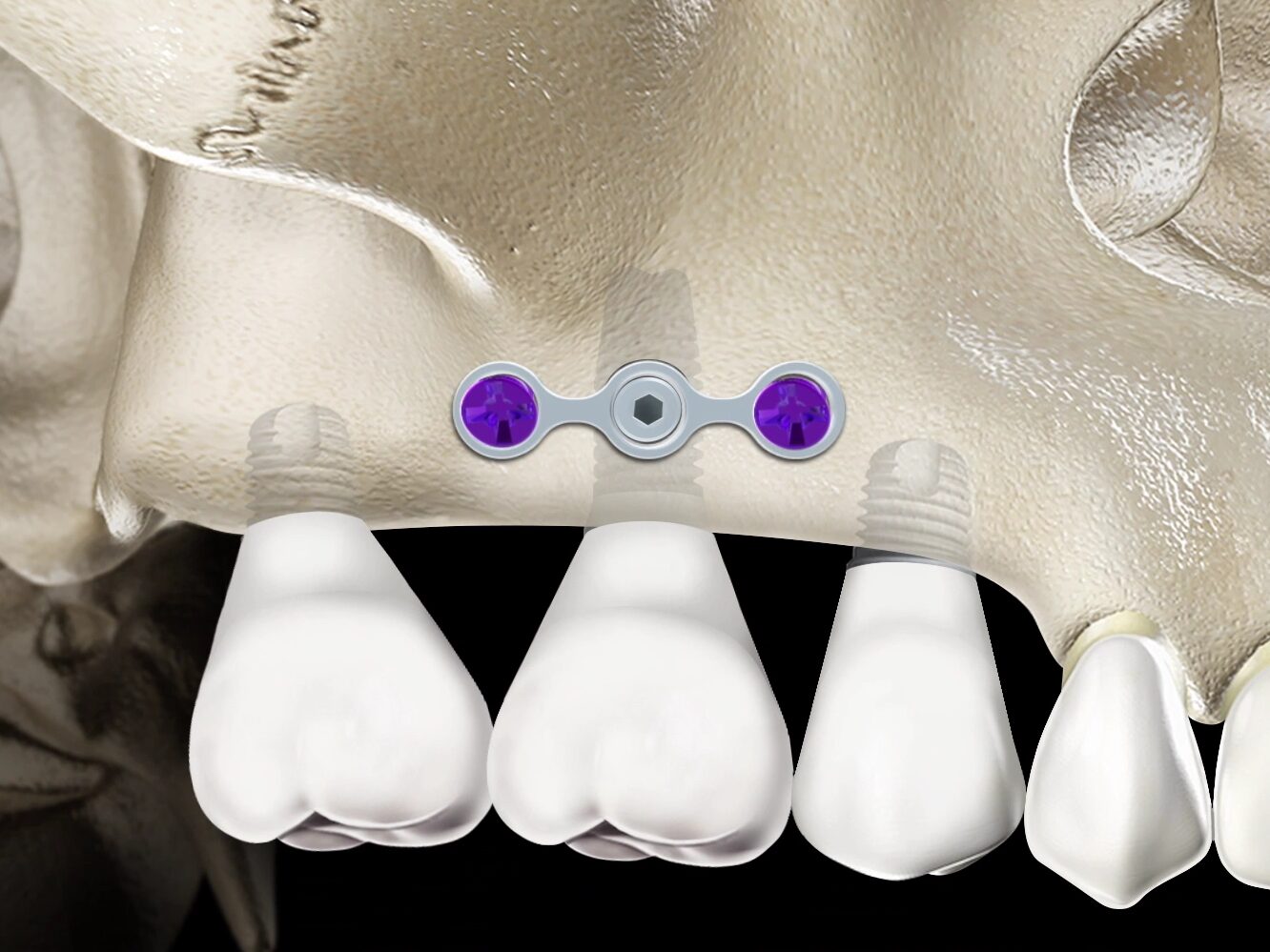 Render di PlateImplant su cresta ossea sottile con viti trasversali