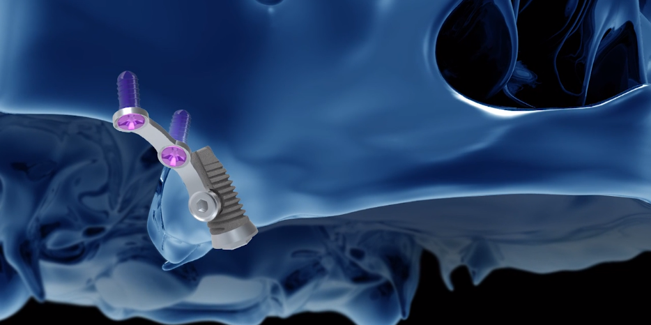 Render di impianto con placca nel mascellare superiore vicino al seno mascellare