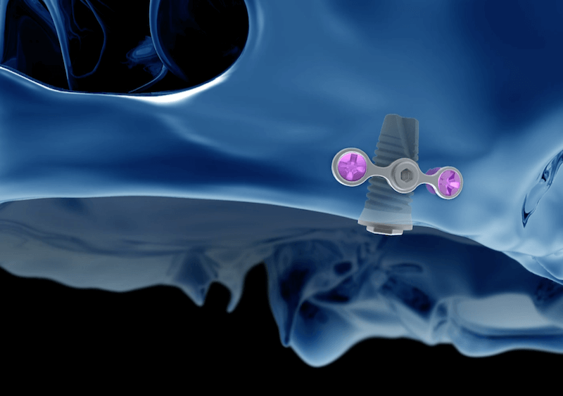 Render di SinusImplant nel mascellare superiore senza rialzo del seno
